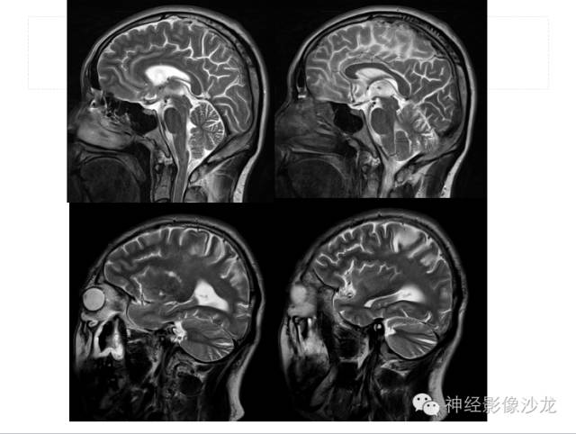 【病例】肝性脑病1例CT及MR影像表现