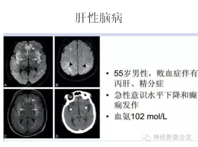 【病例】肝性脑病1例CT及MR影像表现