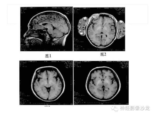 【病例】肝性脑病1例CT及MR影像表现