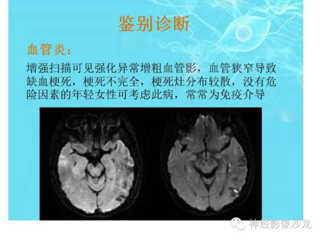 【病例】肝性脑病1例CT及MR影像表现