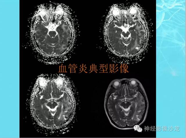 【病例】肝性脑病1例CT及MR影像表现