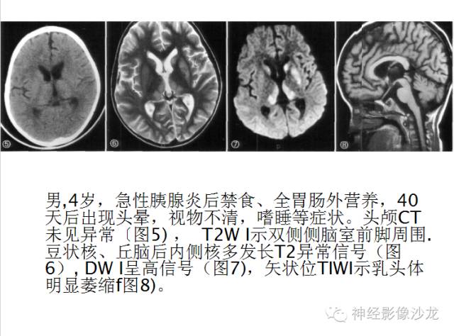 【病例】肝性脑病1例CT及MR影像表现