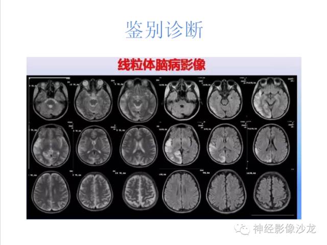 【病例】肝性脑病1例CT及MR影像表现