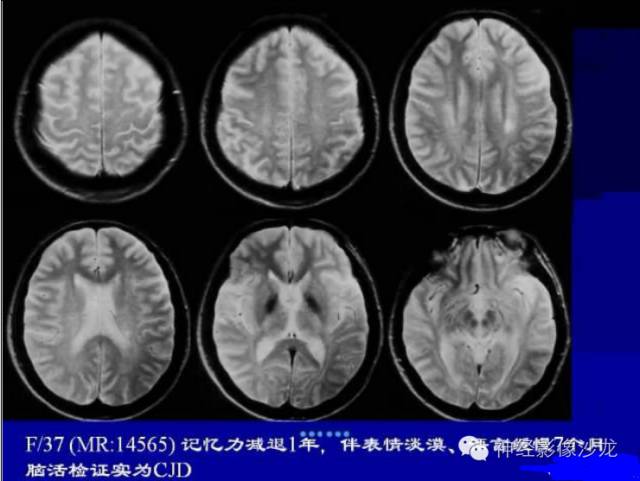 【病例】肝性脑病1例CT及MR影像表现