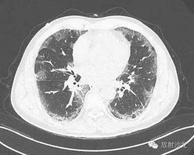 【病例】甲型流感病毒肺炎1例CT影像表现 【病例】甲型流感病毒肺炎1例CT影像表现