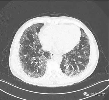 【病例】甲型流感病毒肺炎1例CT影像表现 【病例】甲型流感病毒肺炎1例CT影像表现