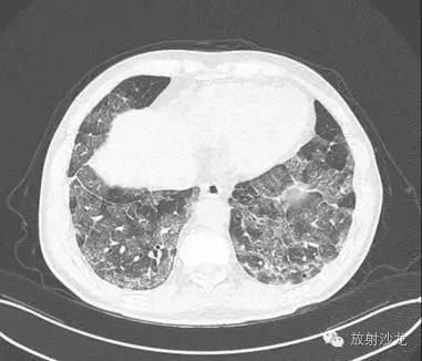 【病例】甲型流感病毒肺炎1例CT影像表现 【病例】甲型流感病毒肺炎1例CT影像表现