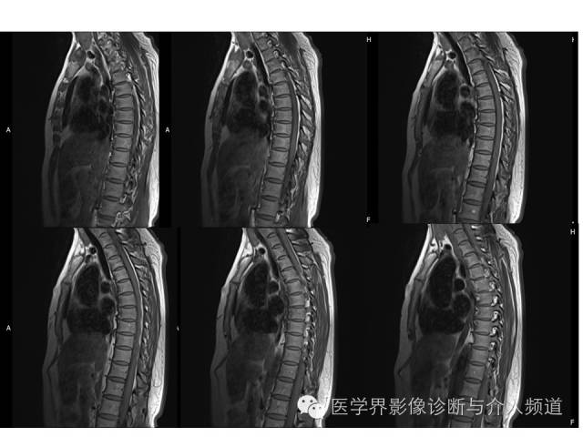 【病例】脊膜瘤1例MR影像表现 【病例】脊膜瘤1例MR影像表现