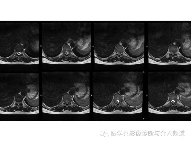【病例】脊膜瘤1例MR影像表现 【病例】脊膜瘤1例MR影像表现