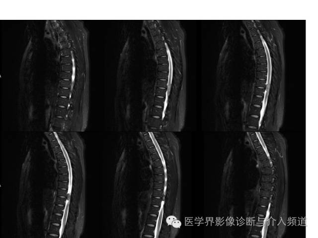 【病例】脊膜瘤1例MR影像表现 【病例】脊膜瘤1例MR影像表现