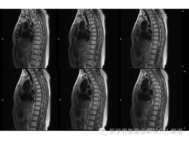 【病例】脊膜瘤1例MR影像表现 【病例】脊膜瘤1例MR影像表现