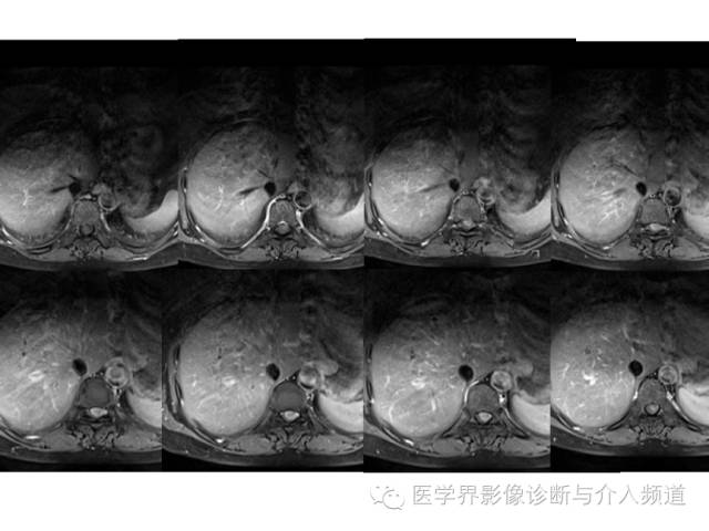 【病例】脊膜瘤1例MR影像表现 【病例】脊膜瘤1例MR影像表现