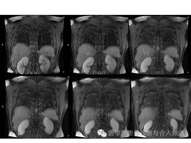 【病例】脊膜瘤1例MR影像表现 【病例】脊膜瘤1例MR影像表现