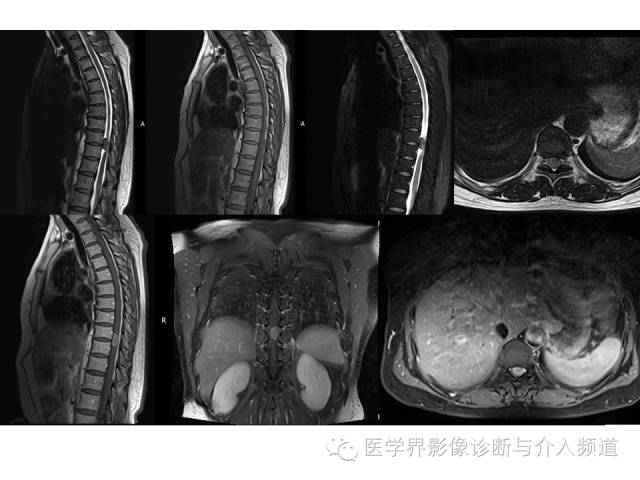 【病例】脊膜瘤1例MR影像表现 【病例】脊膜瘤1例MR影像表现