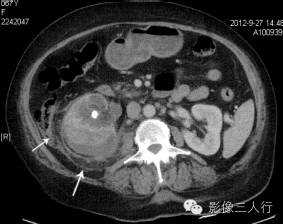 肾周蝴蛛网征（perirenal cobwebs sign）