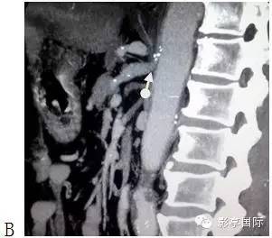 【病例】肠系膜慢性缺血合并盲升结肠末梢血管急性血栓栓塞1例