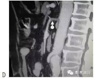 【病例】肠系膜慢性缺血合并盲升结肠末梢血管急性血栓栓塞1例