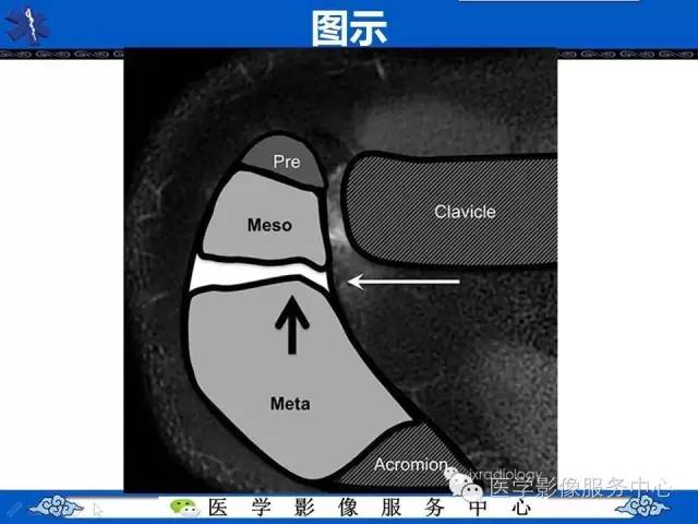 【PPT】80%的医生都不知道的肩峰骨