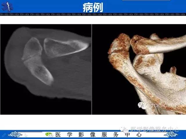 【PPT】80%的医生都不知道的肩峰骨