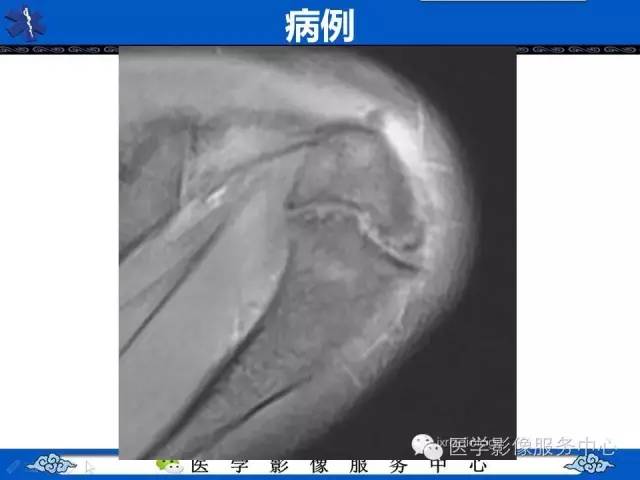 【PPT】80%的医生都不知道的肩峰骨
