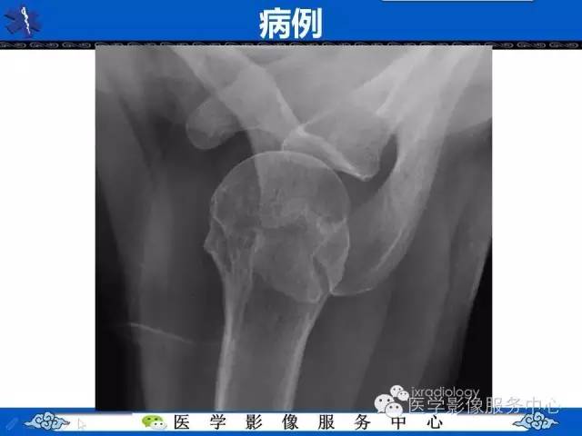 【PPT】80%的医生都不知道的肩峰骨