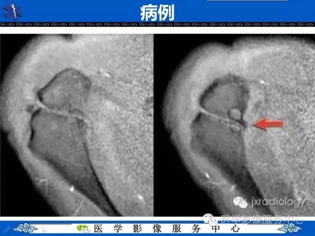 【PPT】80%的医生都不知道的肩峰骨