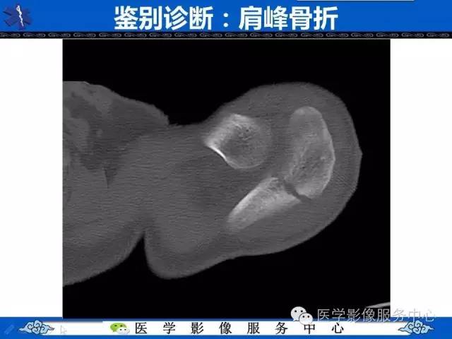 【PPT】80%的医生都不知道的肩峰骨