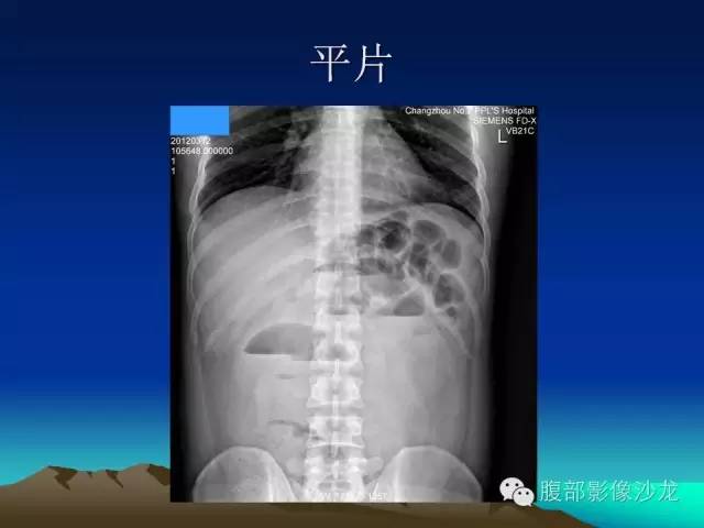【病例】嗜酸性肠炎1例CT影像表现 【病例】嗜酸性肠炎1例CT影像表现