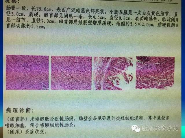 【病例】嗜酸性肠炎1例CT影像表现 【病例】嗜酸性肠炎1例CT影像表现