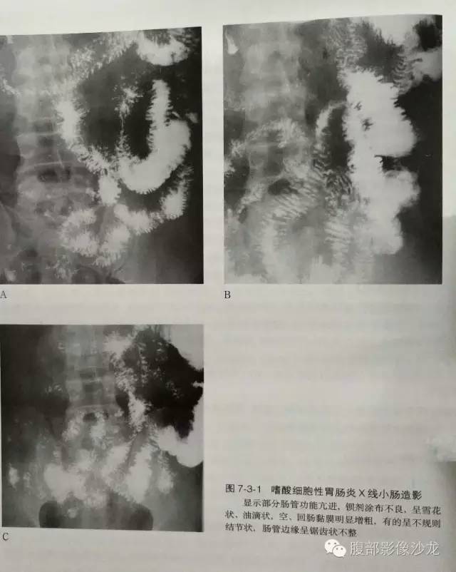 【病例】嗜酸性肠炎1例CT影像表现 【病例】嗜酸性肠炎1例CT影像表现