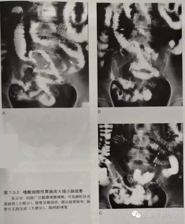 【病例】嗜酸性肠炎1例CT影像表现 【病例】嗜酸性肠炎1例CT影像表现