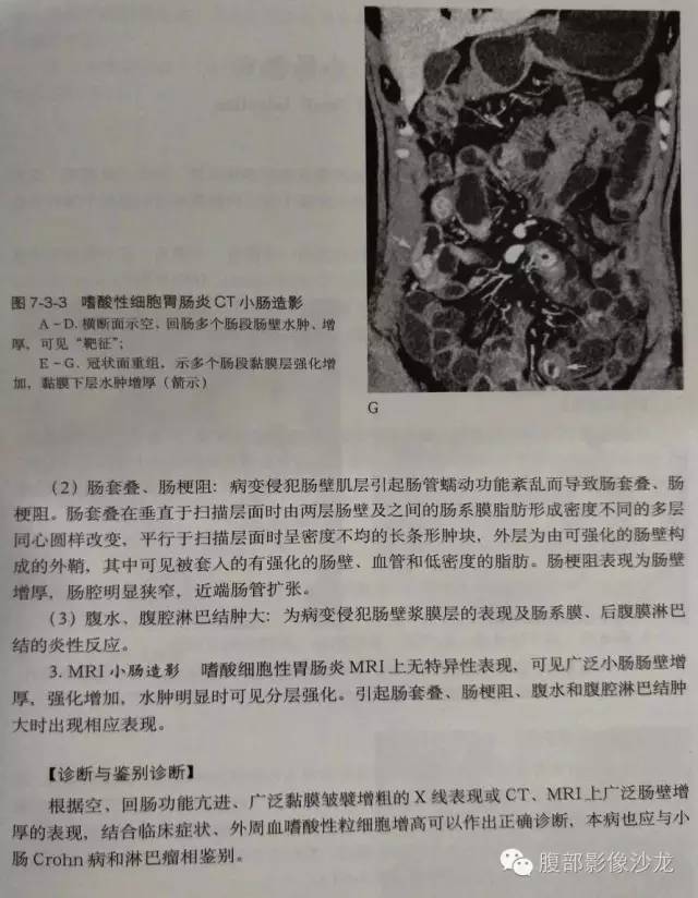 【病例】嗜酸性肠炎1例CT影像表现 【病例】嗜酸性肠炎1例CT影像表现