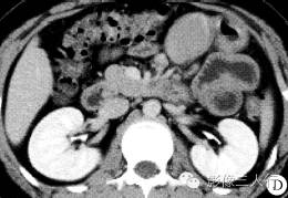 【病例】肠系膜多发巨淋巴结增生症1例CT影像表现 【病例】肠系膜多发巨淋巴结增生症1例CT影像表现