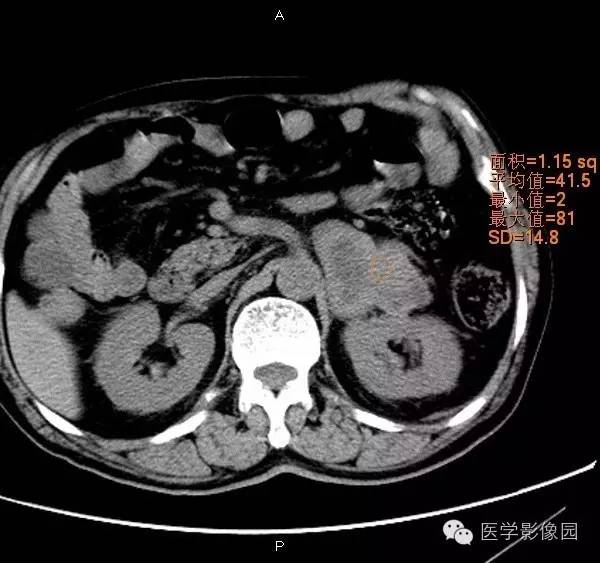 【病例】肾上腺嗜铬细胞瘤1例CT影像表现