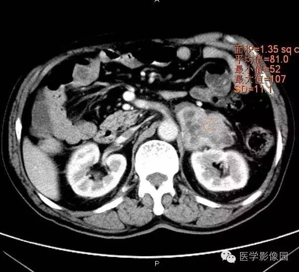 【病例】肾上腺嗜铬细胞瘤1例CT影像表现