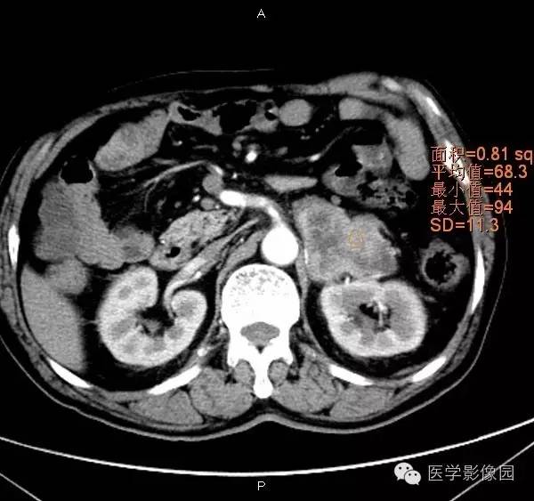 【病例】肾上腺嗜铬细胞瘤1例CT影像表现