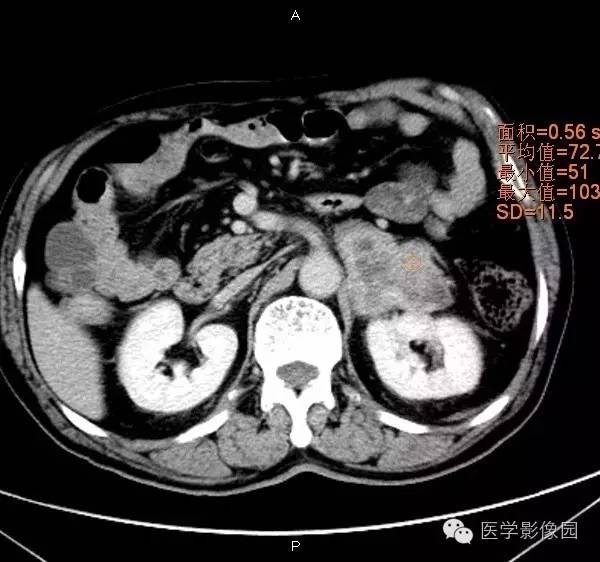 【病例】肾上腺嗜铬细胞瘤1例CT影像表现