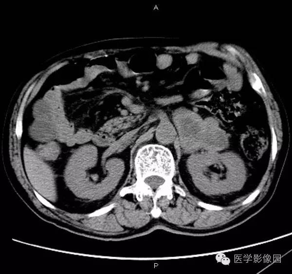 【病例】肾上腺嗜铬细胞瘤1例CT影像表现