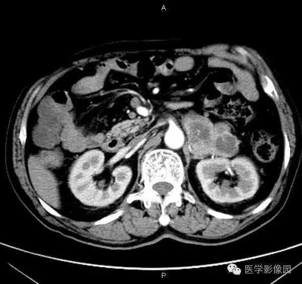 【病例】肾上腺嗜铬细胞瘤1例CT影像表现