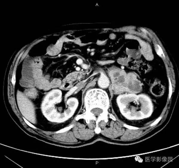 【病例】肾上腺嗜铬细胞瘤1例CT影像表现