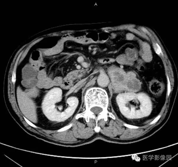 【病例】肾上腺嗜铬细胞瘤1例CT影像表现