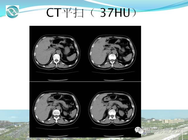 【病例】肝脏淋巴瘤1例CT及MR影像表现 【病例】肝脏淋巴瘤1例CT及MR影像表现