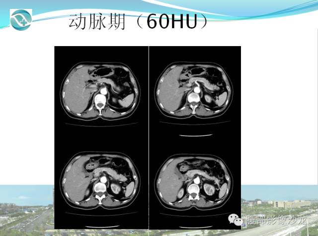 【病例】肝脏淋巴瘤1例CT及MR影像表现 【病例】肝脏淋巴瘤1例CT及MR影像表现