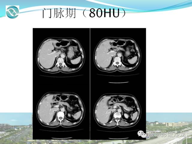 【病例】肝脏淋巴瘤1例CT及MR影像表现 【病例】肝脏淋巴瘤1例CT及MR影像表现