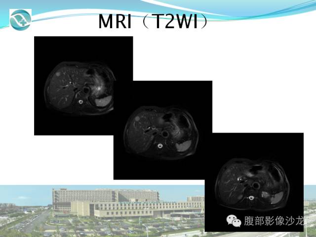 【病例】肝脏淋巴瘤1例CT及MR影像表现 【病例】肝脏淋巴瘤1例CT及MR影像表现
