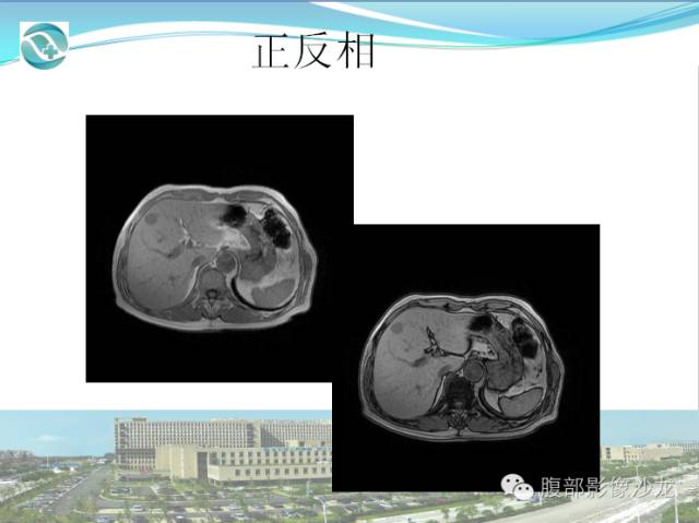 【病例】肝脏淋巴瘤1例CT及MR影像表现 【病例】肝脏淋巴瘤1例CT及MR影像表现