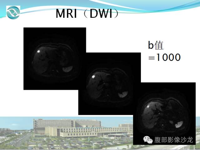 【病例】肝脏淋巴瘤1例CT及MR影像表现 【病例】肝脏淋巴瘤1例CT及MR影像表现