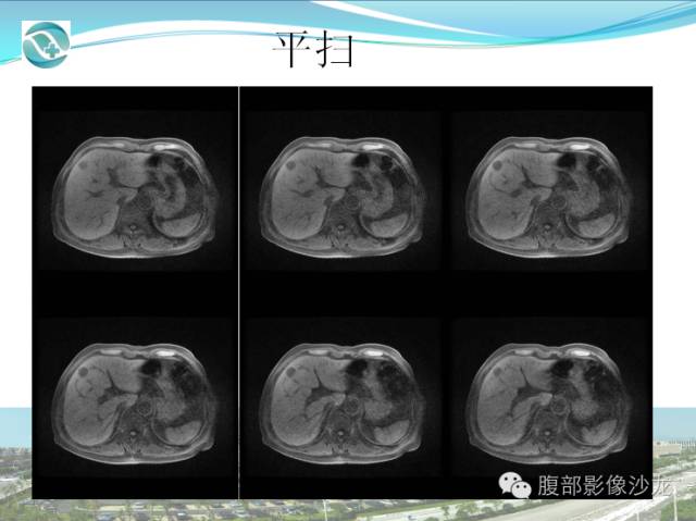 【病例】肝脏淋巴瘤1例CT及MR影像表现 【病例】肝脏淋巴瘤1例CT及MR影像表现