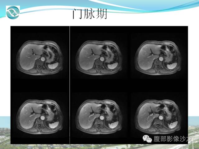 【病例】肝脏淋巴瘤1例CT及MR影像表现 【病例】肝脏淋巴瘤1例CT及MR影像表现