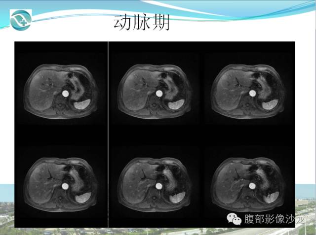 【病例】肝脏淋巴瘤1例CT及MR影像表现 【病例】肝脏淋巴瘤1例CT及MR影像表现